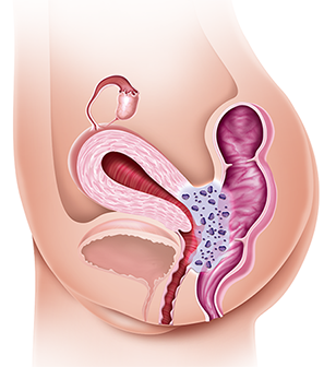 endometriose superficial