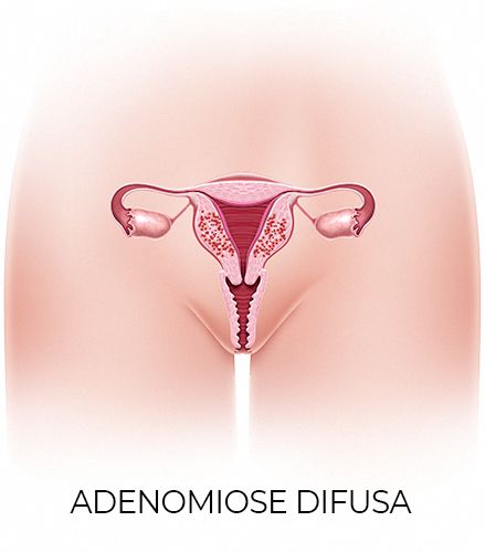 Adenomiose difusa