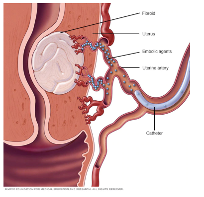 Embolização das artérias uterinas