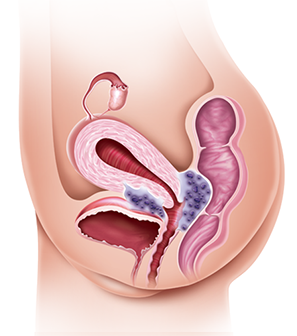 endometriose superficial