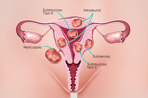 tipos de miomas