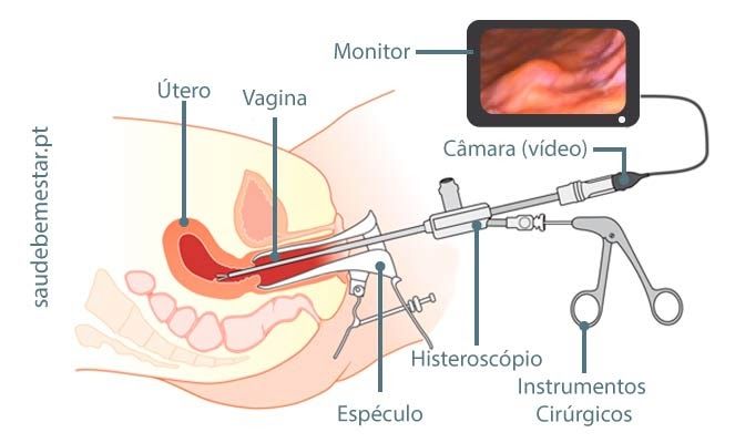 heteroscopia