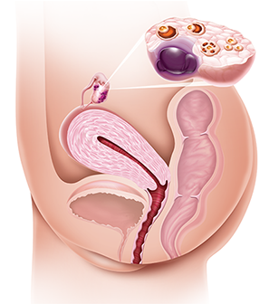 endometriose superficial