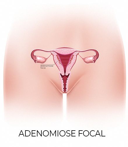 Adenomiose focal